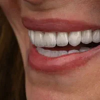 دندونت زرد و شکسته داغونه بیا روکش سرامیکی کن