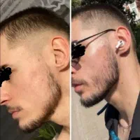 ضمامنتی برای رفع کم پشتی