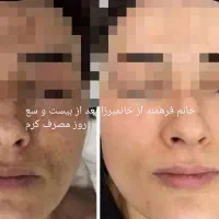 کرم معجزه اصل ضد لک و جوش سفید شدن پوست ضمانتی|آرایشی، بهداشتی، درمانی|لردگان, |دیوار