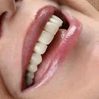 ایمپلنت اقساطی عصبکشی روکش لمینت دندانپزشکی قسطی