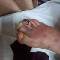 پانسمان نوین زخم بستر / دیابتی / سوختگی / سرطانی|خدمات آرایشگری و زیبایی|ارومیه, |دیوار