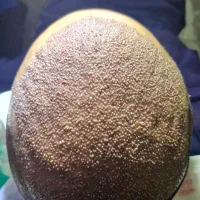 کاشت موی طبیعی