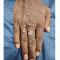 درمان خانگی زگیل و تبخال تناسلی|آرایشی، بهداشتی، درمانی|اصفهان, شهرک زاینده رود|دیوار