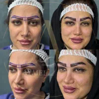 کاشت ابرو وموcip دربیمارستان ضمانتدار ۱۱ تومن