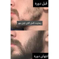 تقویت و رویش ریش دیگه مد شده این روش