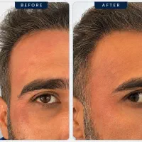فیلر لب روسی فیلر زیر چشم فیلر گونه چانه توسط پزشک|خدمات زیبایی و سلامت|شیراز, ملاصدرا|دیوار