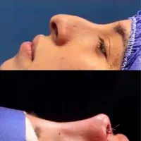 عمل بینی بندرعباس،اقساطی،باکیفیت و تضمین