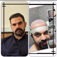کاشت مو ابرو با تخفیف عالی
