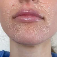 آموزش و خدمات تکنیک پوست مار و مزونیدلینگ|خدمات آرایشگری و زیبایی|اسلام‌شهر, باغ فیض|دیوار