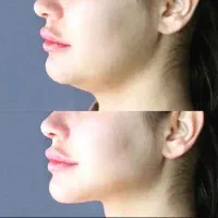 جراحی پلک(بلفاروپلاستی) / جراحی بینی/ جراحی غبغب|خدمات آرایشگری و زیبایی|شیراز, قصرالدشت|دیوار