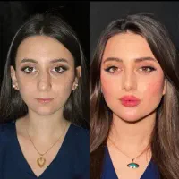 تزریق ژل فیلربوتاکس تخفیفات50درصدی برای زیباجویان|خدمات آرایشگری و زیبایی|زاهدان, |دیوار