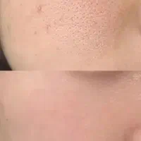 پاکسازی و جوانسازی پوست با تجهیزات پیشرفته