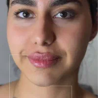 ژل و بوتاکس