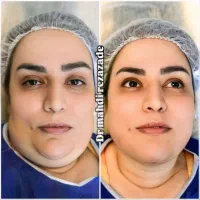 تخفیف ویژه، ساکشن تزریق چربی بلفارو کانتو اپیکانتو|خدمات آرایشگری و زیبایی|مشهد, هفت تیر (حافظ)|دیوار