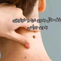 حذف فوری خال منگوله ای