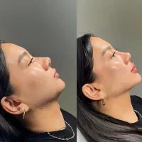 جشنواره  تزریق ژل  لب روسی وبوتاکس انزیم فیلر|خدمات آرایشگری و زیبایی|کرج, گلشهر|دیوار