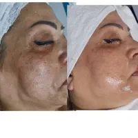 آموزش پاکسازی و فیشیال  بصورت انلاین