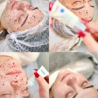 فیشال،اسکالپ سر،ماساژ آلگاپیل طب سوزنی توسط پزشک