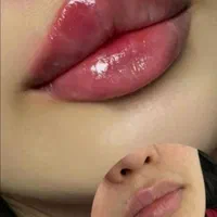 جشنواره تزریق ژل و بوتاکس وانزیم