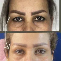 تخفیف یلدایی افتادگی پلک