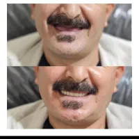دندانسازی  دندان مصنوعی  پروتز دندان|خدمات آرایشگری و زیبایی|قم, کلهری|دیوار