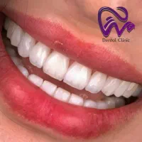 کامپوزیت دندان لبه شیشه ای اقساط بدون سود ،|خدمات آرایشگری و زیبایی|تهران, قیطریه|دیوار