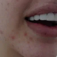 تخفیفات ویژه کامپوزیت در درمانگاه تخصصی یاسوج|خدمات آرایشگری و زیبایی|یاسوج, |دیوار