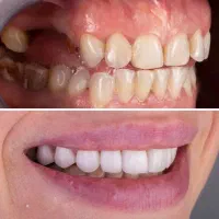 تخفیف ویژه ده روزه ایمپلنت