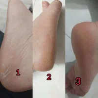 درمان انواع مشکلات پوست و مو|آرایشی، بهداشتی، درمانی|بروجرد, |دیوار