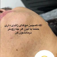 لیزر موهای زائد با سری شخصی تضمینی وکیل آباد|خدمات آرایشگری و زیبایی|مشهد, هفت تیر (حافظ)|دیوار