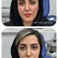 دکتر کامبیز محمدپور«ایرانا»تالیامعجزه تزریق فیلرژل