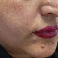 برداشتن انواع خال و لک و کک و مک|خدمات آرایشگری و زیبایی|نورآباد, |دیوار