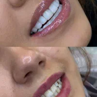 جشنواره دندانپزشکی کامپوزیت لمینت