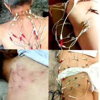 فیزیوتراپی طب سوزنی فصد حجامت زالو در منزل|خدمات آرایشگری و زیبایی|تهران, ایران|دیوار