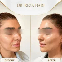 قسطی فیلربادی کانتور۴لیفت کره ای ژل لب هیپدیپ باسن