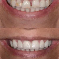 دندانپزشکی/لمینت/روکش|خدمات آرایشگری و زیبایی|تهران, فلسطین (میدان انقلاب)|دیوار