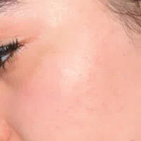 فرمول ساخت کرم سفید کننده و از بین برنده جوش و لک