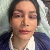 جراحی پلک با بخیه لیزری توسط جراح متخصص زیبایی|خدمات آرایشگری و زیبایی|تهران, تجریش|دیوار