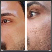 تضمینی برای همیشه جای جوشاتو ببر