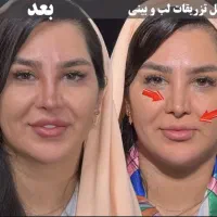تزریق ژل و بوتاکس بهاره|خدمات زیبایی و سلامت|تهران, نعمتآباد|دیوار