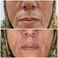 تزریق فیلر (ژل) بوتاکس مزو  در کلینیک ونوس با قی|خدمات آرایشگری و زیبایی|تهران, حر|دیوار