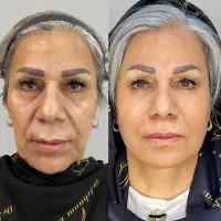 هایفو و پکیج جوانسازی پوست ویژه جشنواره روز مادر