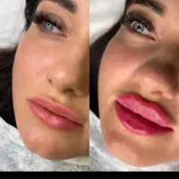 جشنواره تخفیف بوتاکس|خدمات آرایشگری و زیبایی|قم, صفاشهر|دیوار