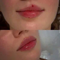 ژل بوتاکس فیلر زاویه سازی خط لبخند لیزر مطب پزشک|خدمات آرایشگری و زیبایی|قم, ارم|دیوار