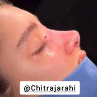 عمل بینی قسطی محدود