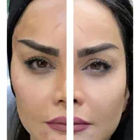 بلفاروپلاستی لیفت ابرو  ساکشن غبغب لیفت با نخ