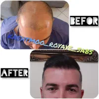 کاشت مو و ابروی طبیعی