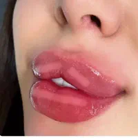 مدل ژل لب گونه چونه زاویه خط خنده ۴۰۰ ت|خدمات آرایشگری و زیبایی|قم, تولید دارو و یخچال|دیوار