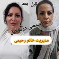 تزریق (ژل،بوتاکس،نخ)قیمت مناسب|خدمات آرایشگری و زیبایی|ملارد, |دیوار