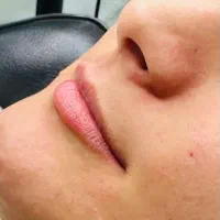 تزریق ژل و بوتاکس